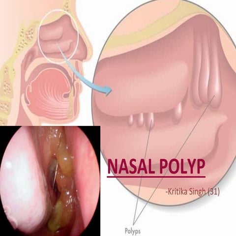 Nasalpolyps 