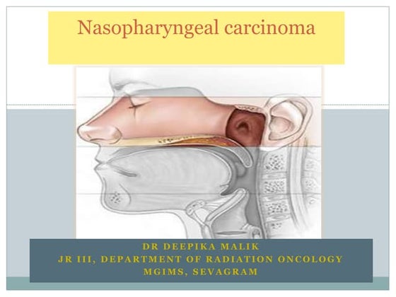 Nasopharyngeal carcinoma | PDF