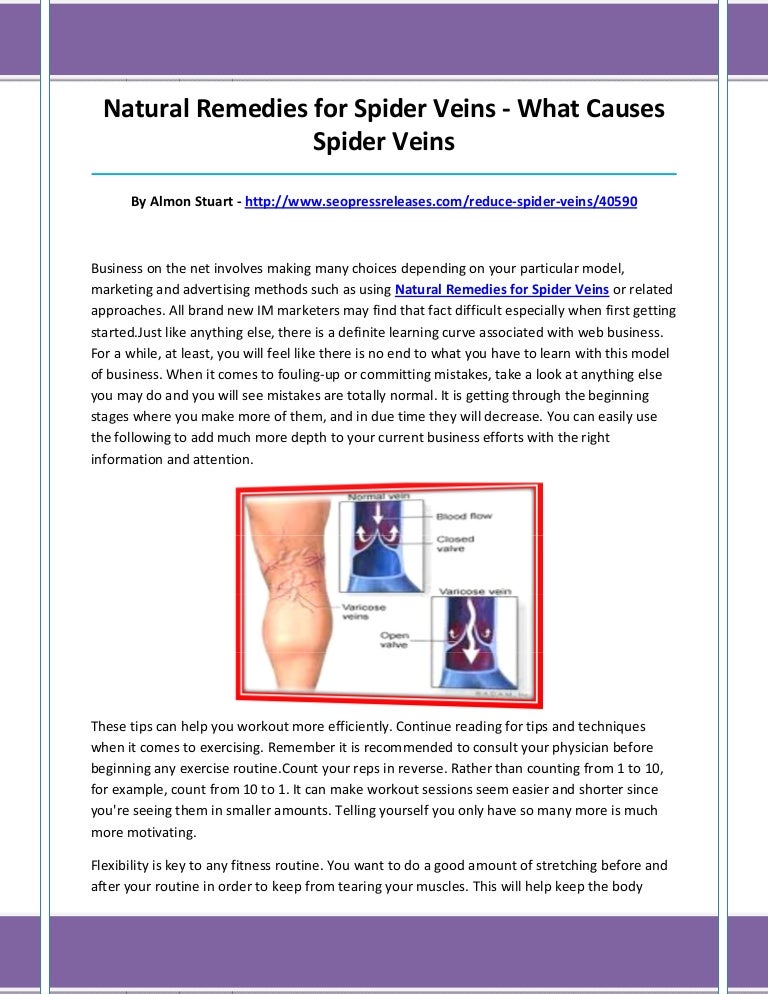 Natural remedies for spider veins