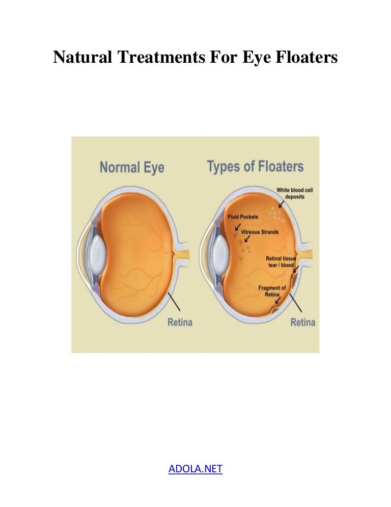 Natural treatments for eye floaters