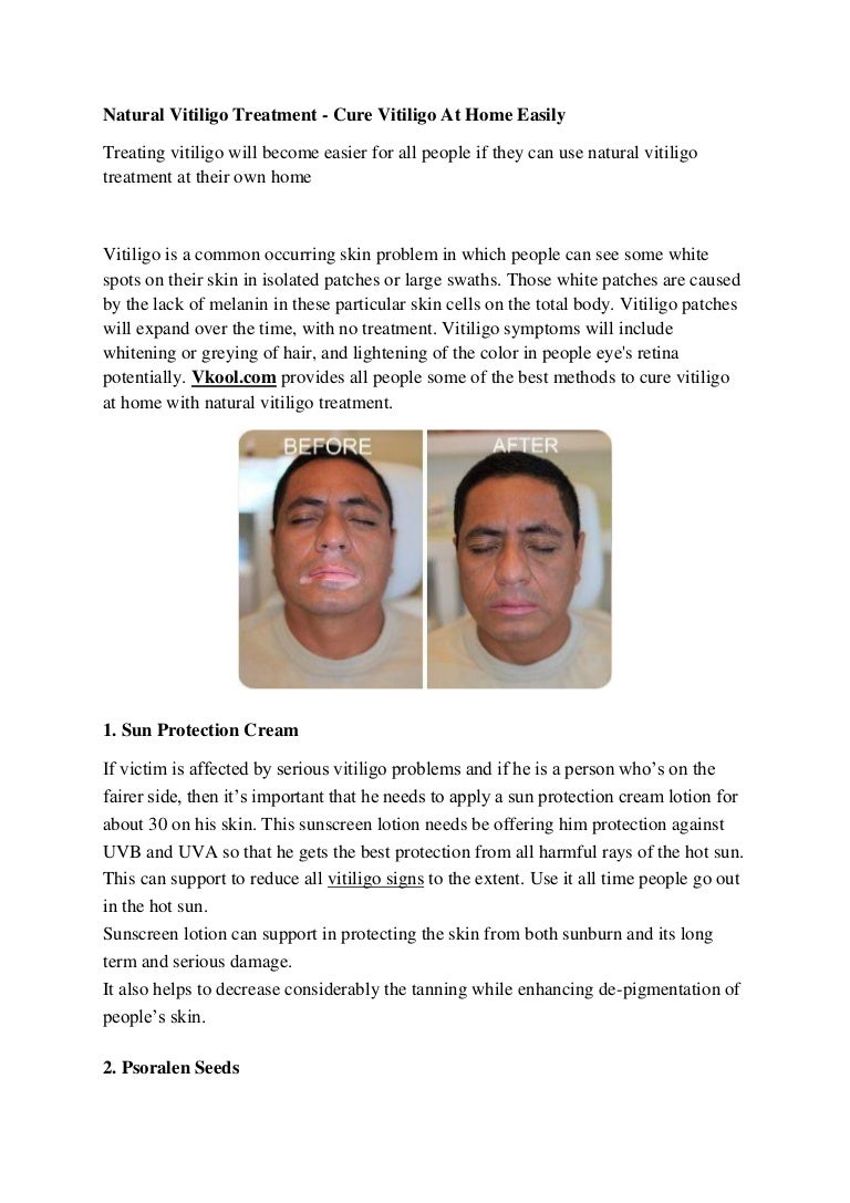 cure vitiligo in 30 days