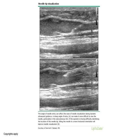 Needle tip visualization | PPTX