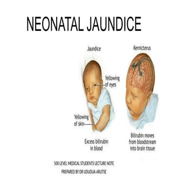 Neonatal jaundice presentation | PPTX