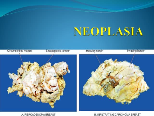 Neoplasia Characteristics and classification of cancer | PPTX