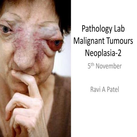 Neoplasia Lab-2 Malignant Tumours