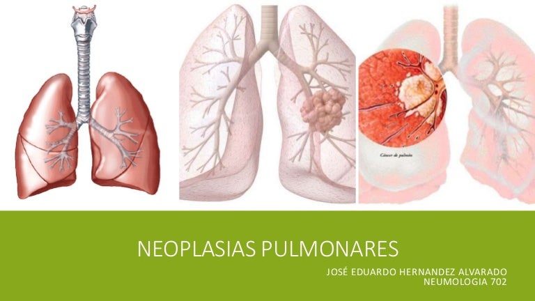 Neoplasias pulmonares