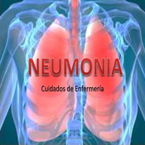 Neumonía. Cuidados de Enfermería (Diagnósticos, NIC y NOC)