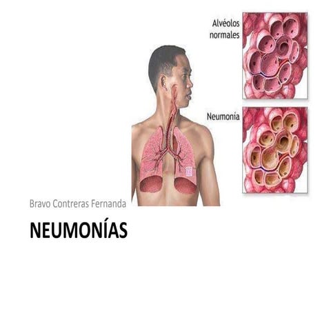 Neumonia