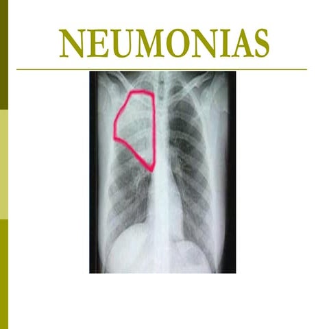 Neumonia