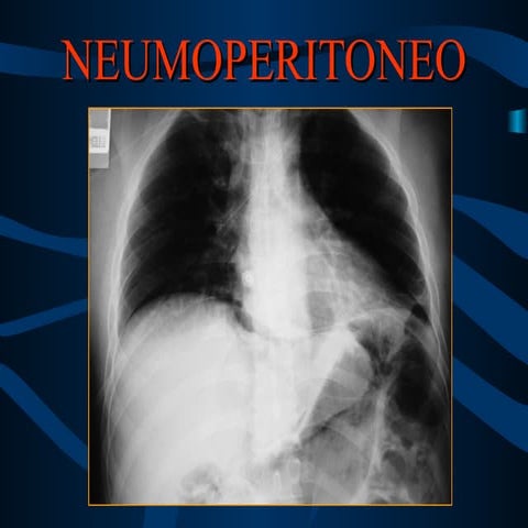 Neumoperitoneo PPT
