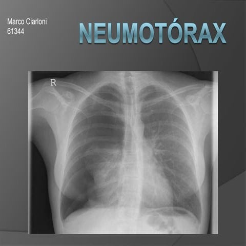 Neumotórax