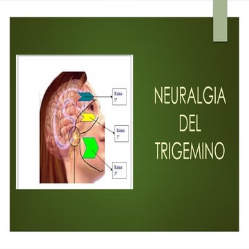 Neuralgia del trigemino | PPTX