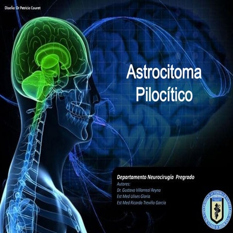 Neurocirugia   astrocitoma pielocitico