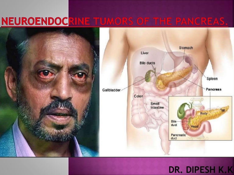 neuroendocrine cancer uptodate)