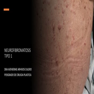 Neurofibromatosis | PPTX
