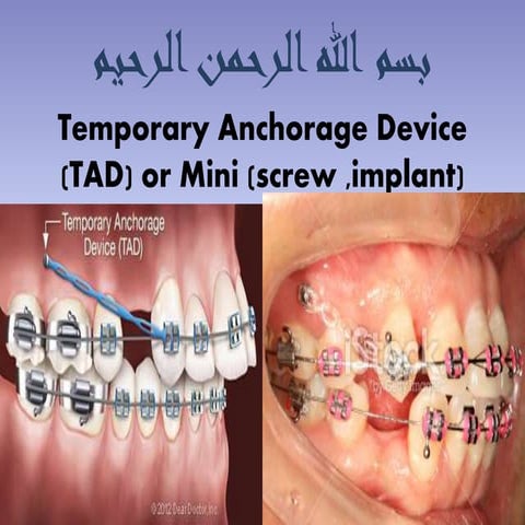 Temporary Anchorage Device (TAD) or Mini (screw ,implant)