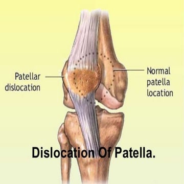 patellar dislocation