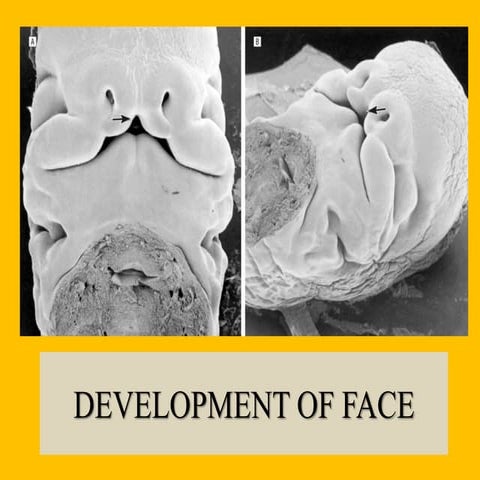 Development of Face and Palate including Anomalies of palate 