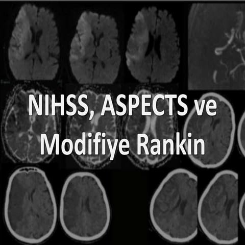 NIHSS, ASPECTS ve Modifiye Rankin Skalası