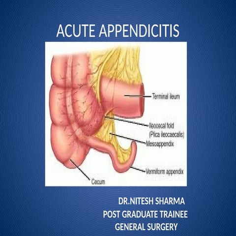 Acute appendicitis | PPTX