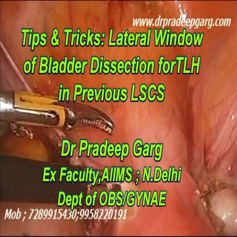 Tips & Tricks for bladder dissection in Lap Hysterectomy in cases of previous LSCS ; Dr Pradeep Garg
