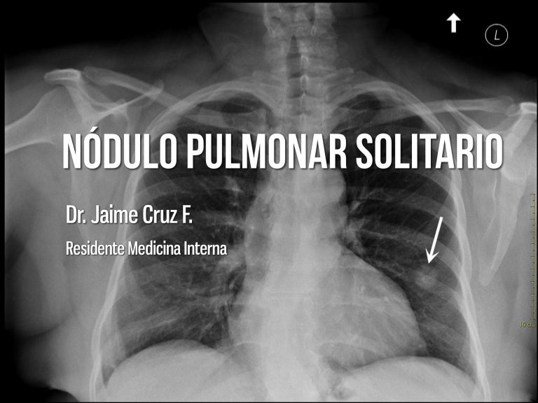Nodulo pulmonar solitario