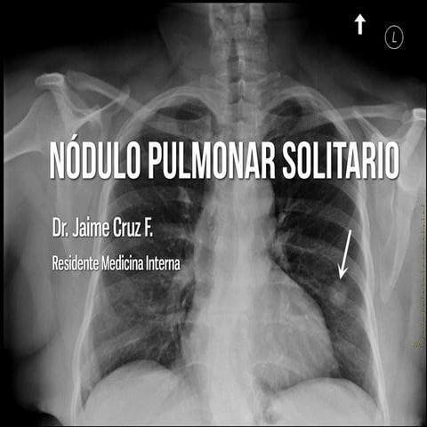 Nodulo pulmonar solitario
