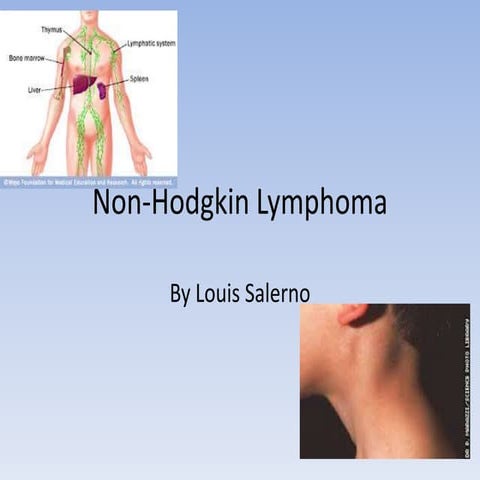 Non hodgkin lymphoma | PPTX
