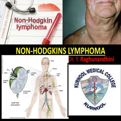 Non hodgkins lymphoma nandhu