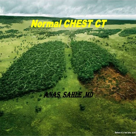 Normal chest ct
