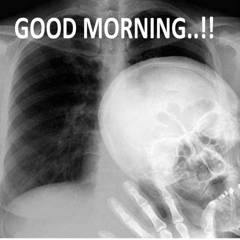 Normal chest x ray