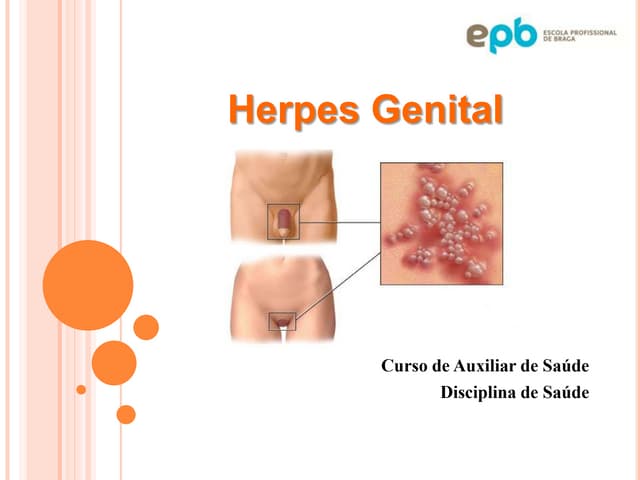 Herpes Genital
