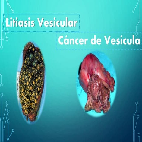 LITIASIS VESICULAR - CANCER DE VESICULA
