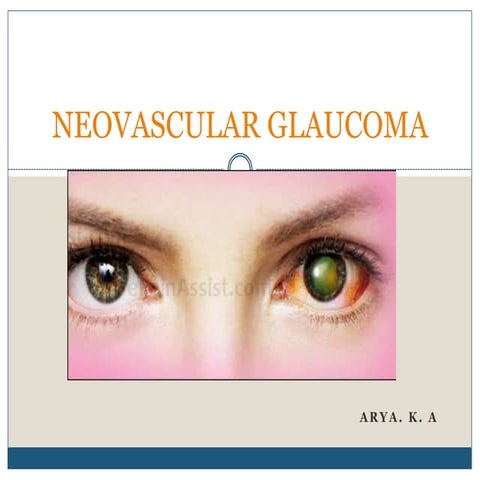 Neovascular glaucoma