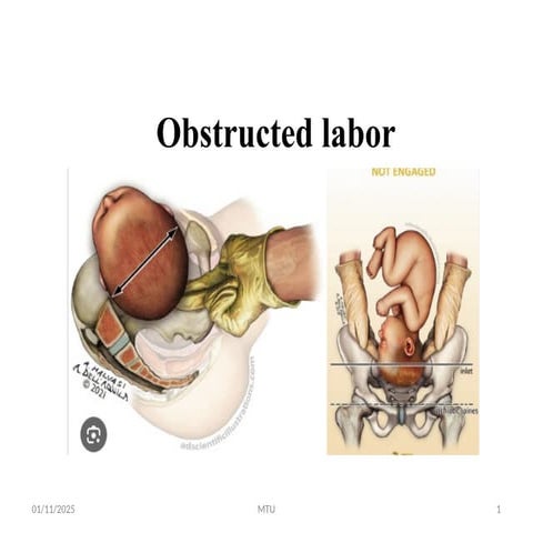 Obstructed labor for midwifery students .pptx