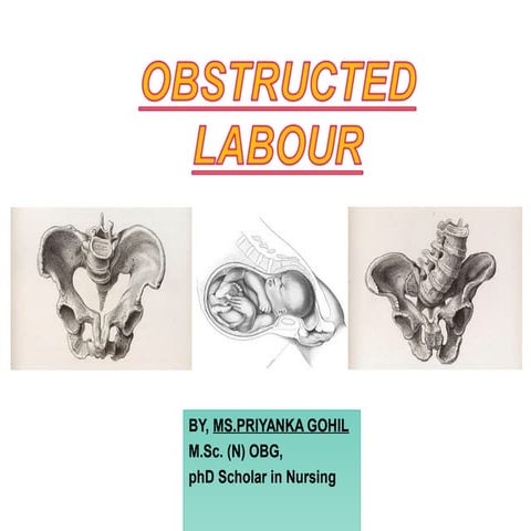 Obstructed labour
