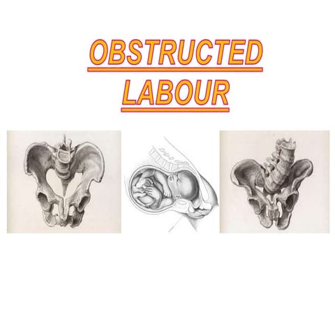 Obstructed Labor and Management in Obstetrics