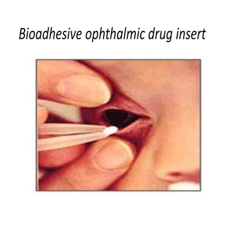 Bioadhesive ophthalmic drug insert | PPTX