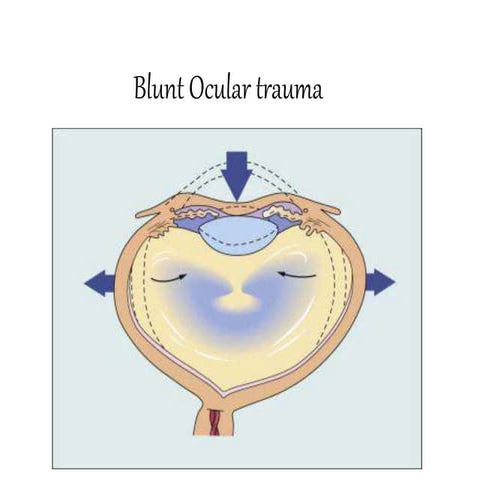 Blunt Ocular trauma 