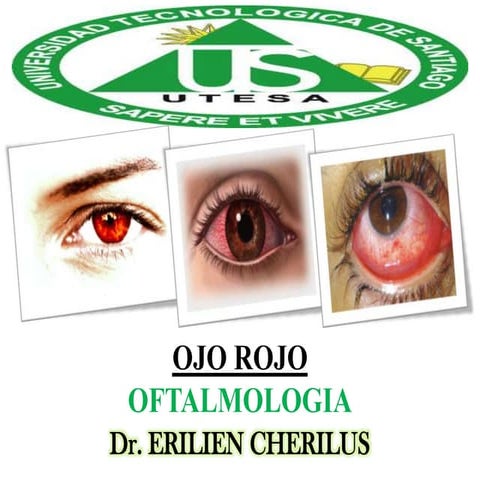 Ojo rojo - Oftalmologia