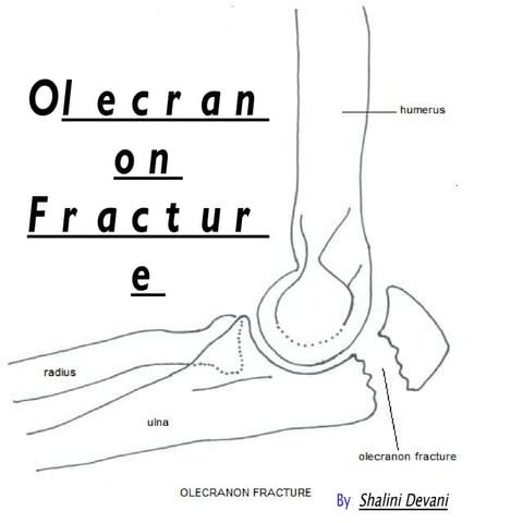 Olecranon fracture