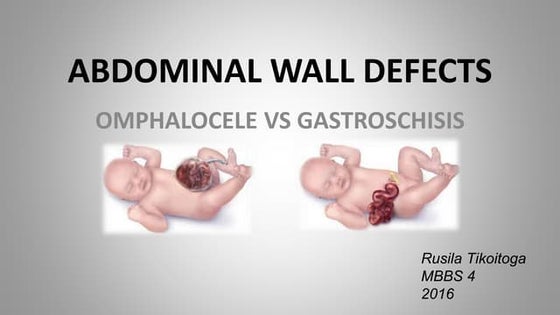 Abdominal wall defects | PPTX