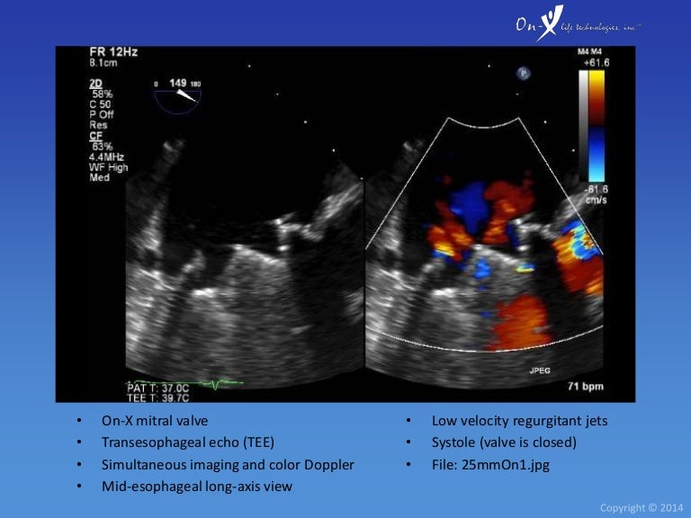OnX Heart Valve Echocardiography
