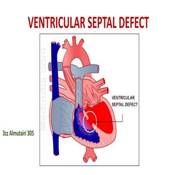 ventricular septal defect
