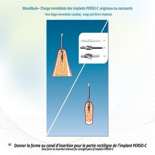 One stage immediateloading