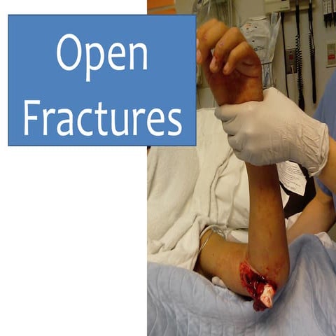 Open fractures