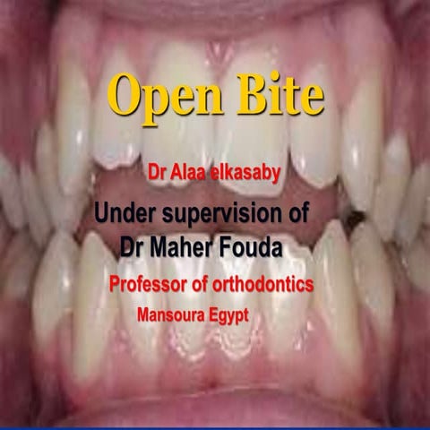 Open bite 