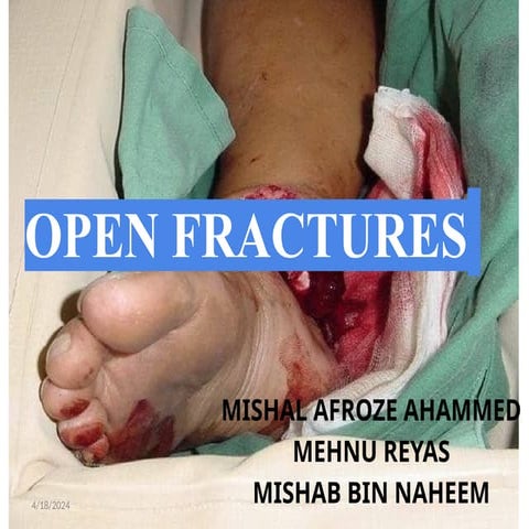 Open Fractures including introduction and conclusion .pptx
