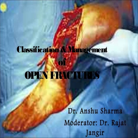Open Fractures Classification and Management.