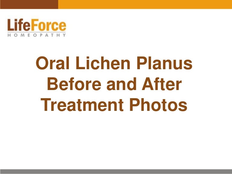 Oral Lichen Planus Photos Before and After Treatment Pictures of Mou…
